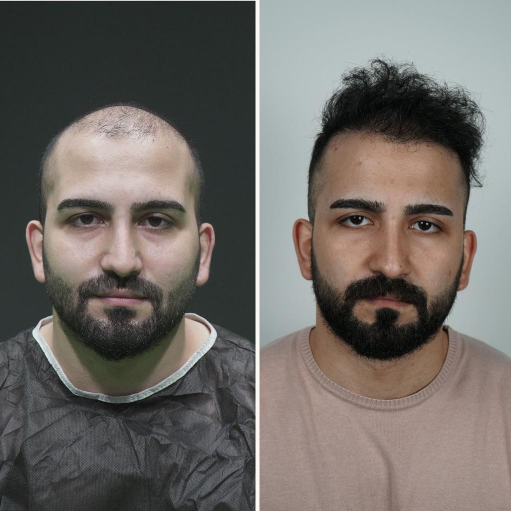 prima e dopo trapianto capelli 13